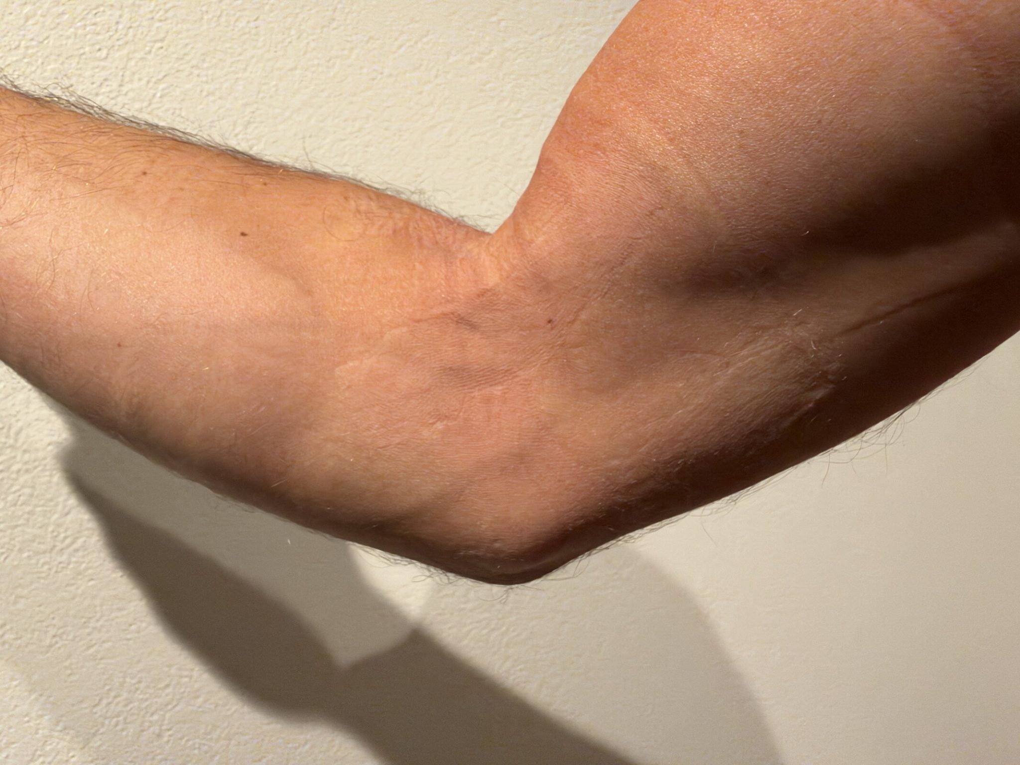 Bare right arm bent at the elbow against a white wall, three days after a sup race injury, with faint marks from the wrap on the skin